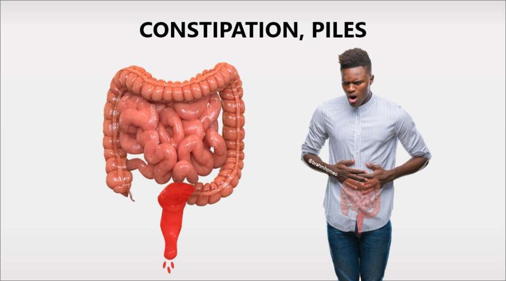 Symptoms of Piles and Constipation - Causes of Piles and Constipation - Homeopathic Treatment for Piles and Constipation